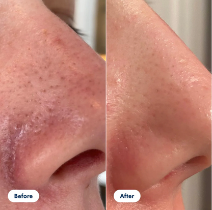 Peel Shot Blackhead Remover